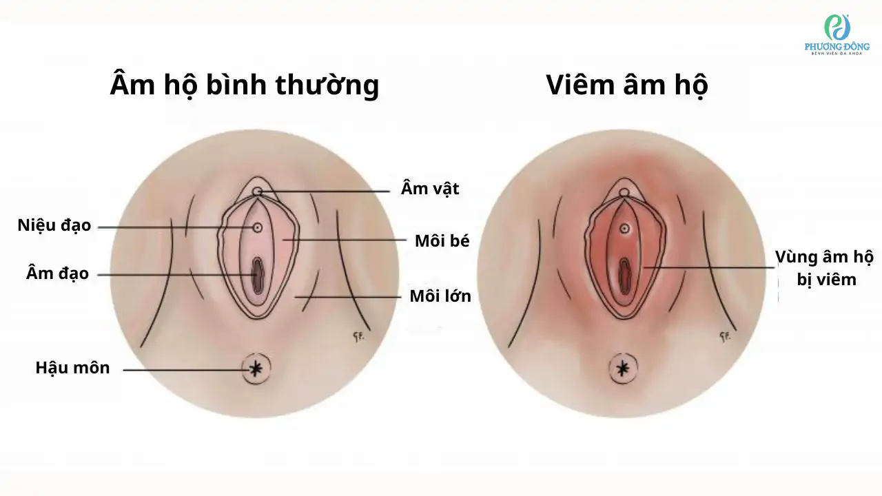 So sánh triệu chứng nhẹ và nặng của bệnh phụ khoa