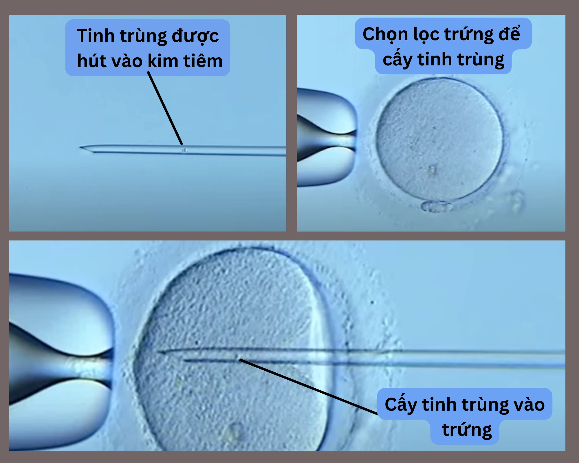 điều trị vô sinh bằng phương pháp icsi và ivf công nghệ mới trong lĩnh vực hiếm muộn tại việt nam