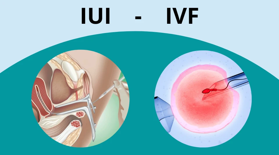 so sánh iui và ivf cách lựa chọn phương pháp sinh sản phù hợp