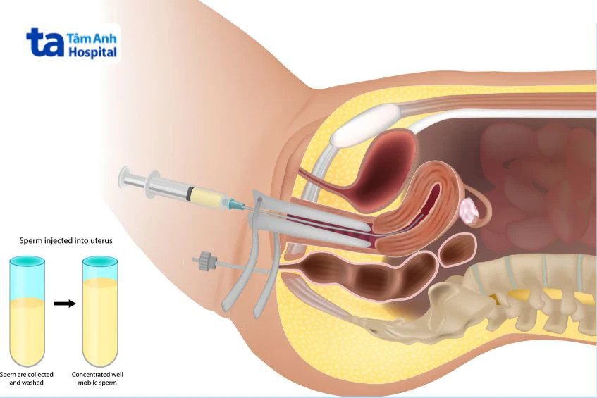 bơm tinh trùng vào buồng tử cung (iui) cách lựa chọn phương pháp sinh sản phù hợp