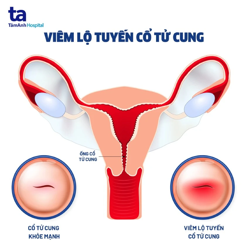 Triệu chứng viêm cổ tử cung mắc bệnh phụ khoa