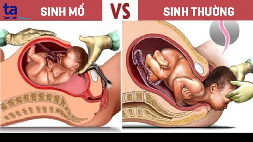 tình trạng sức khỏe của mẹ cách lựa chọn phương pháp sinh sản phù hợp