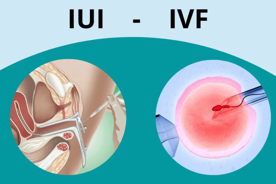 thụ tinh nhân tạo (iui) phương pháp điều trị hiếm muộn