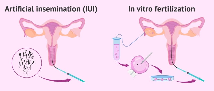 so sánh giữa các phương pháp điều trị hiếm muộn