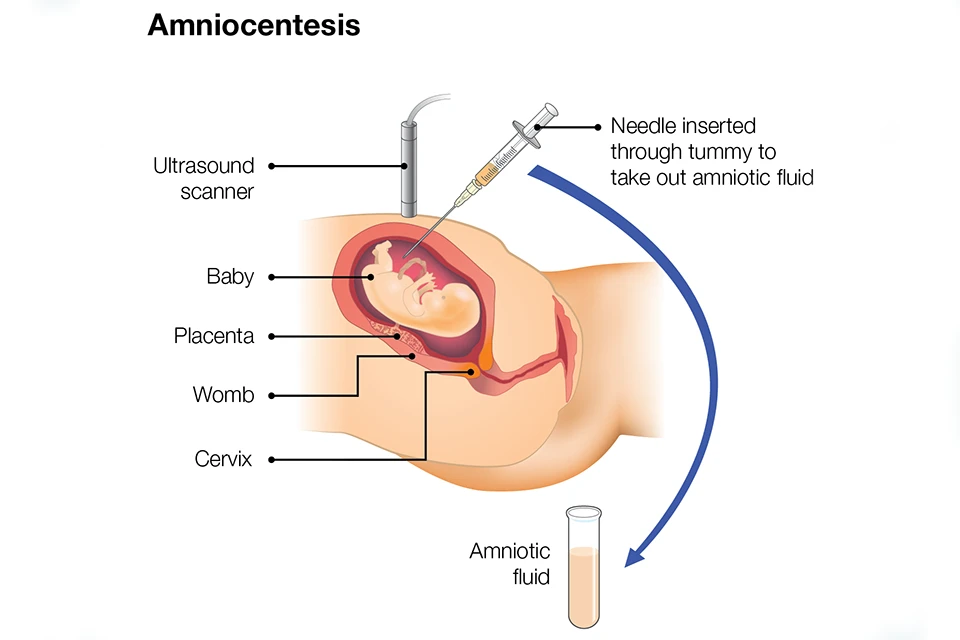 Những yếu tố nguy cơ khiến mẹ bầu cần chọc dò nước ối và sinh thiết nhau thai: khi nào thiết?