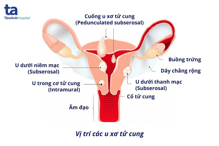 U xơ tử cung khám phụ khoa: