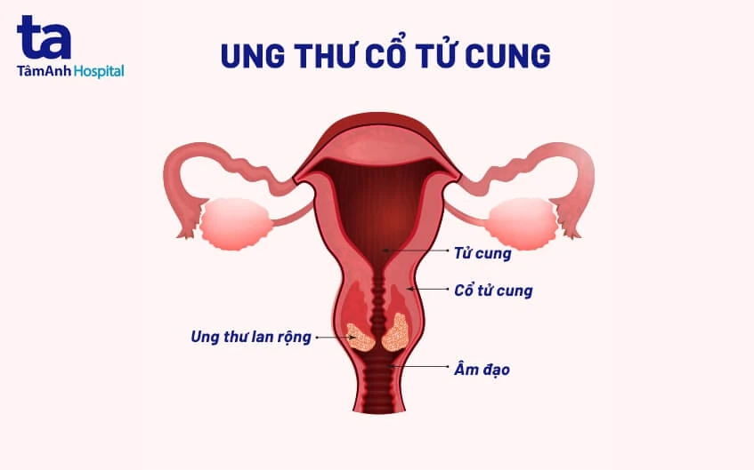 Ung thư cổ tử cung khám phụ khoa: