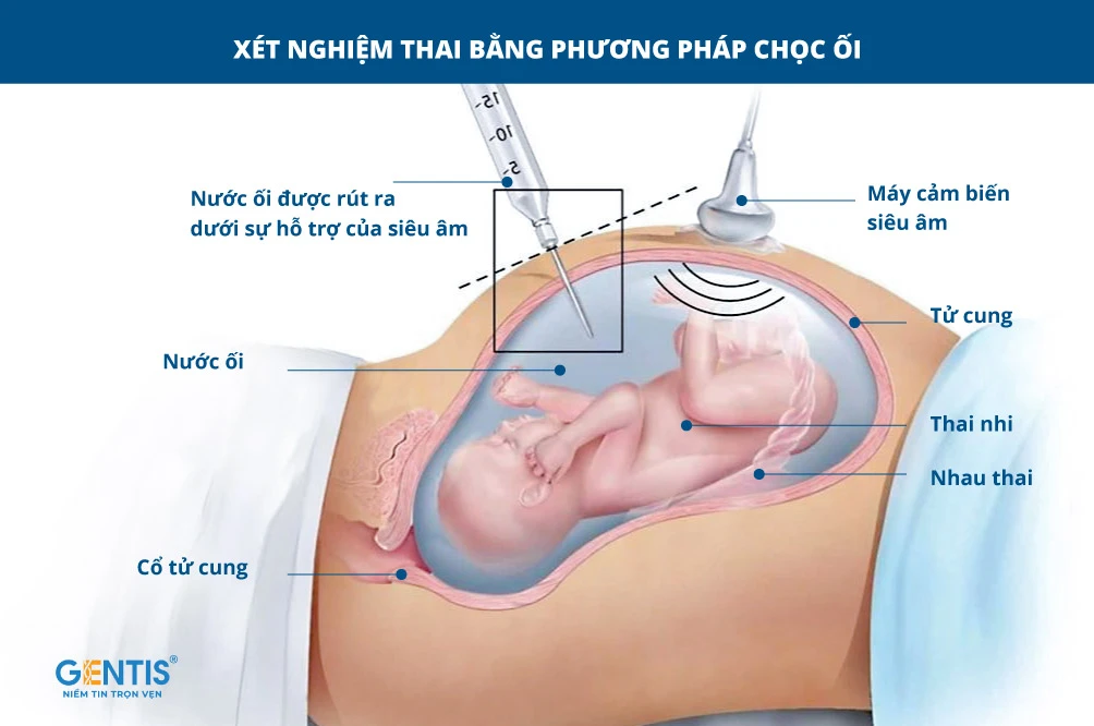 So sánh giữa thời điểm sinh thiết nhau thai và chọc dò nước ối thai: khi nào cần thiết?