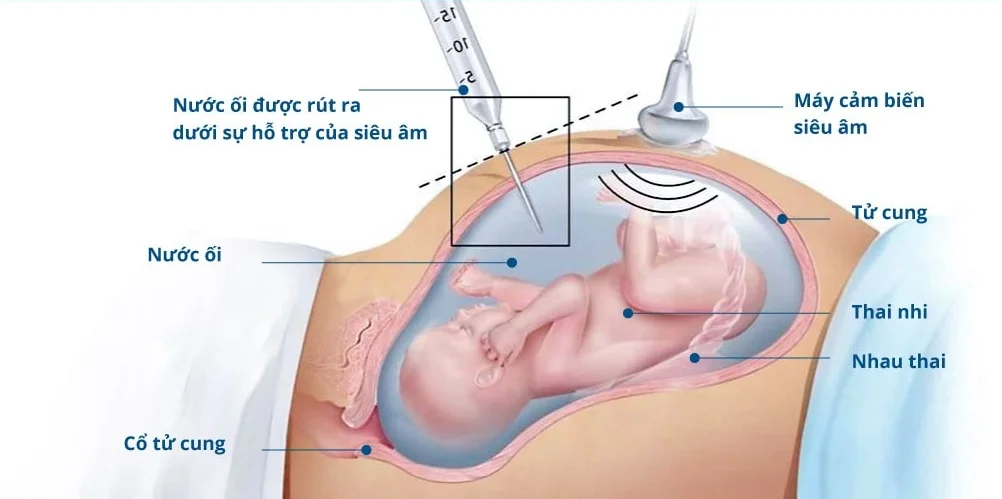 Các câu hỏi thường gặp về chọc dò nước ối và sinh thiết nhau thai thai: khi nào cần thiết?