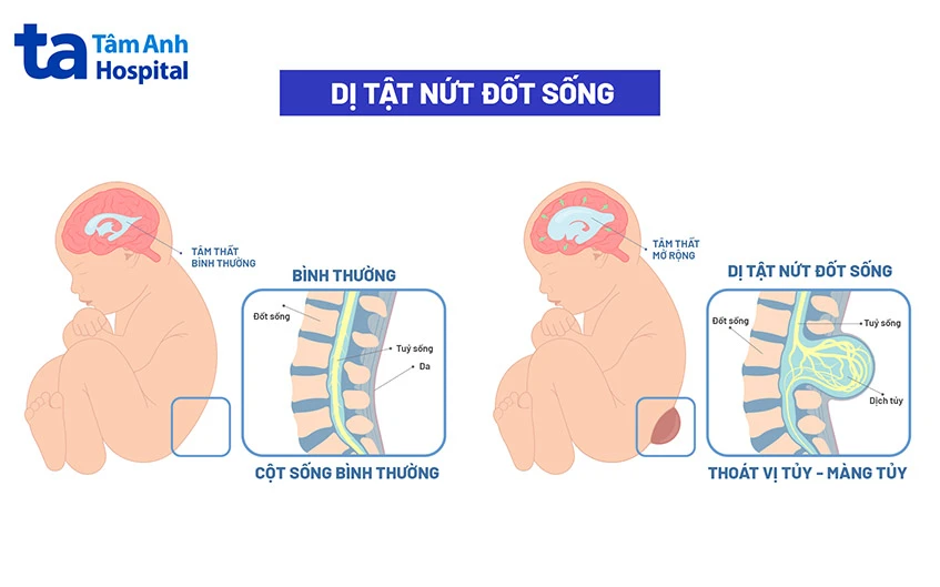 Liều lượng khuyến cáo của axit folic trong thai kỳ