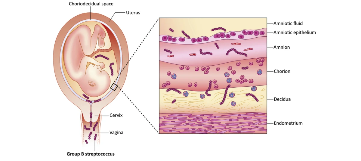 Những trường hợp đặc biệt cần xét nghiệm sớm GBS (liên cầu khuẩn nhóm b): tầm quan trọng và thời điểm thực hiện